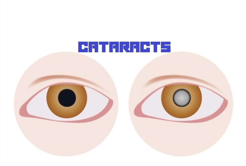 A Clear Look at Cataracts