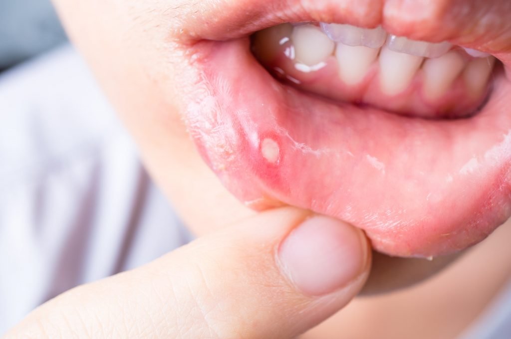 does diabetes cause mouth sores?